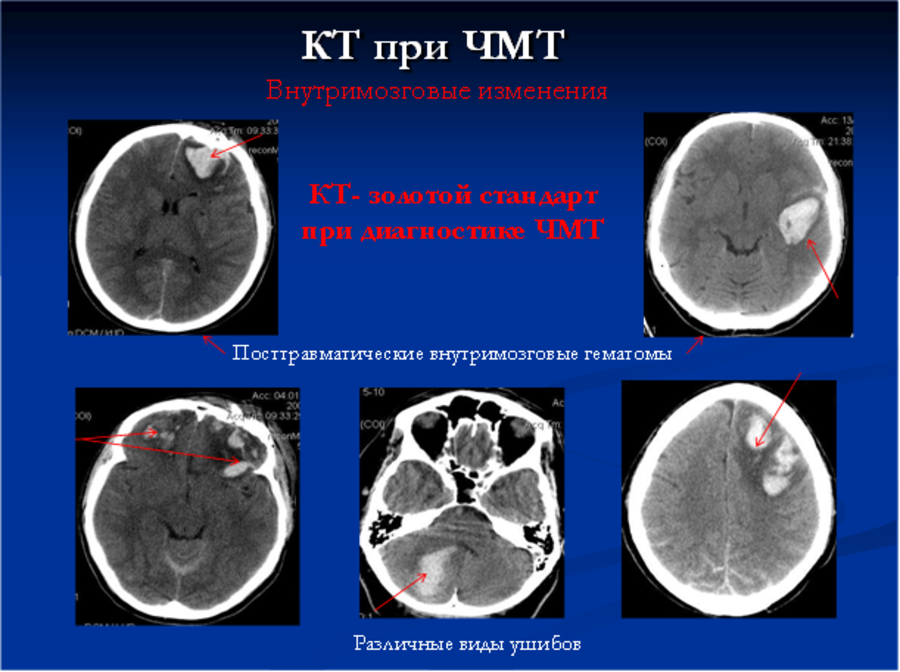 МРТ при сотрясении головного мозга - что покажет